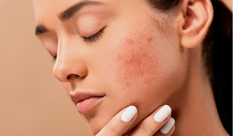 Effective acne and pimple care products in India